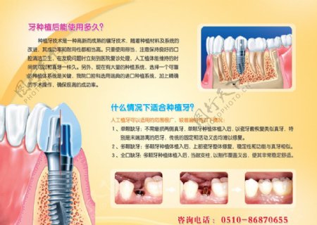 种植牙牙种植图片