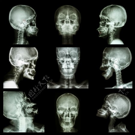 脑X光片图图片