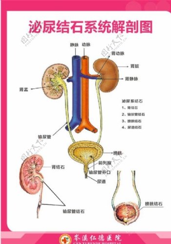 泌尿结石