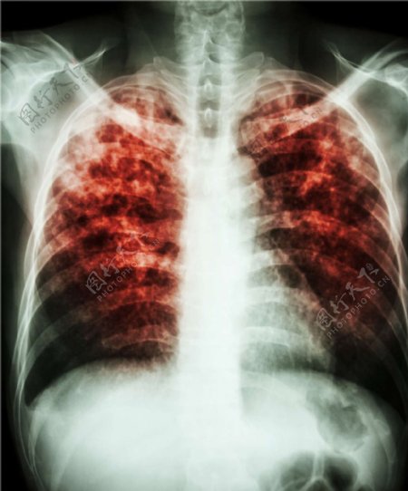 胸腔X光片图片