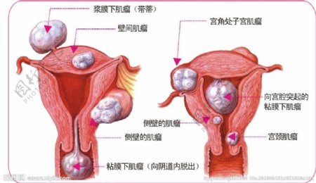 子宫肌瘤图片