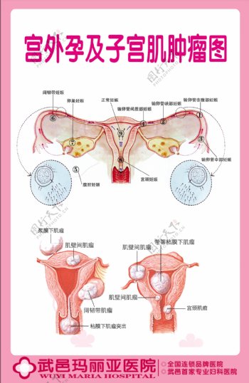 宫外孕及子宫肌肿瘤图图片