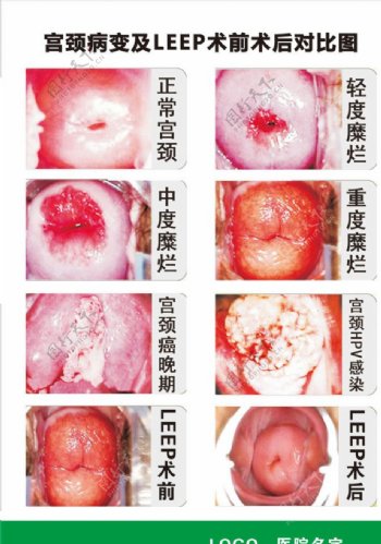 宫颈病变和LEEP图片