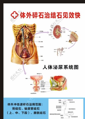 体外碎石图片